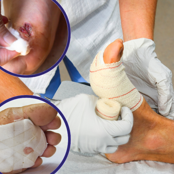 diabetic foot ulcer treatment