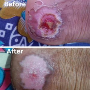 Wound treatment - Dr. Amsaveni