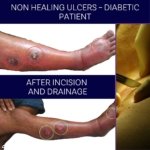 Non healing ulcer treatment - Dr. Amsaveni Health Clinic