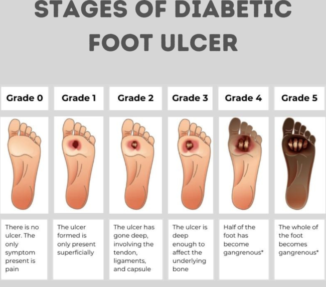 stages of diabetic foot ulcer