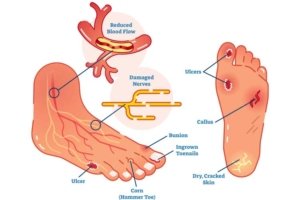 understanding-Diabetic-Foot-ulcer