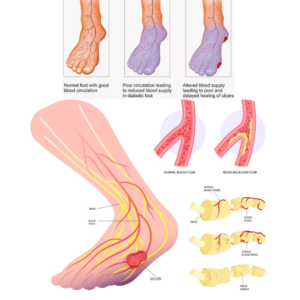 what is diabetic foot ulcer