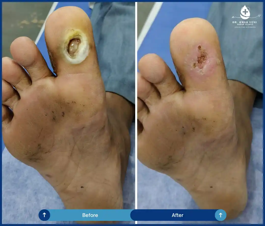 Best Treatment For Diabetic Foot Ulcers Img4