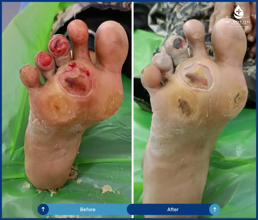 Best Treatment For Diabetic Foot Ulcers Img5