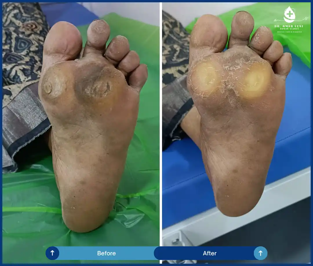 Best Treatment For Diabetic Foot Ulcers Img6