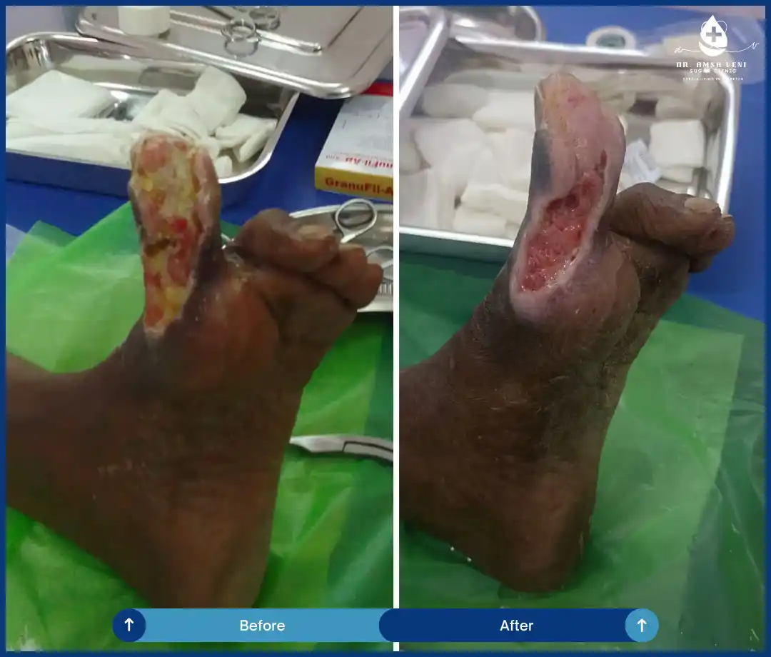 Best Treatment For Diabetic Foot Ulcers Img7