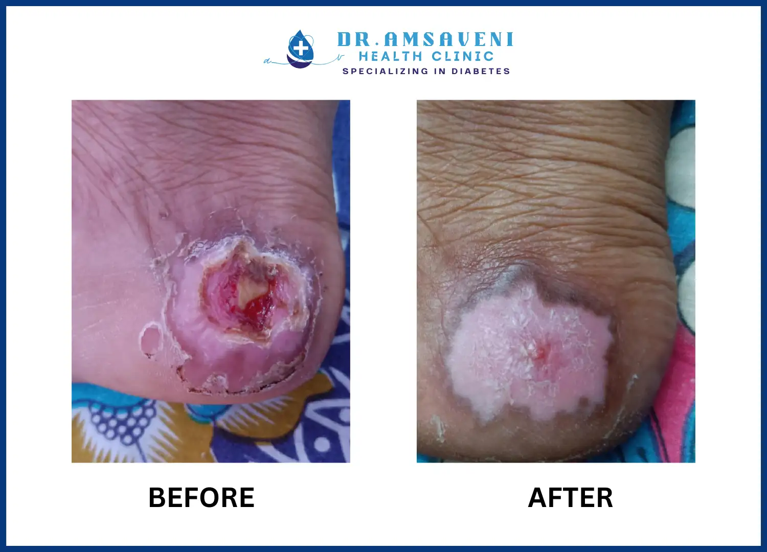 Diabetic Foot Ulcer Treatment Wound Care