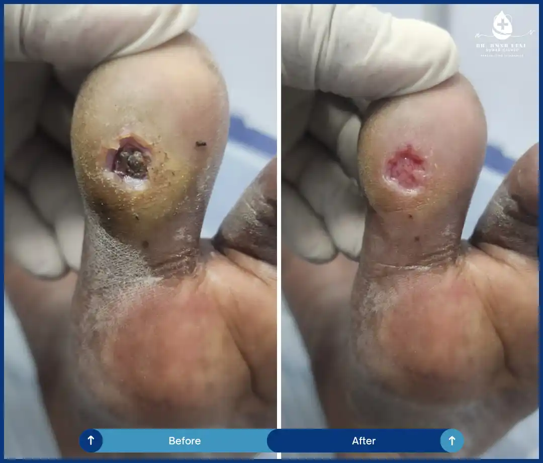 Diabetic Foot Ulcer Treatment and Recovery Img1