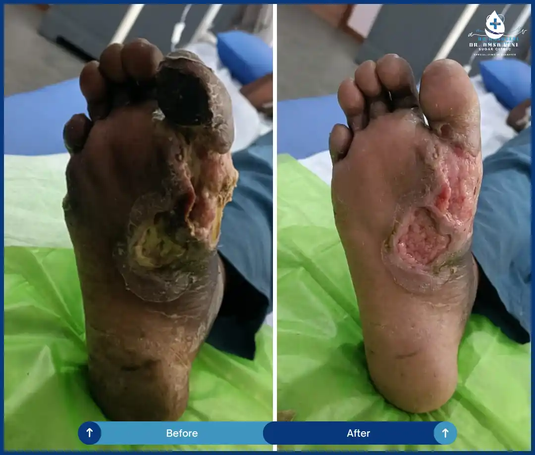 Diabetic Foot Ulcer Treatment and Recovery Img2
