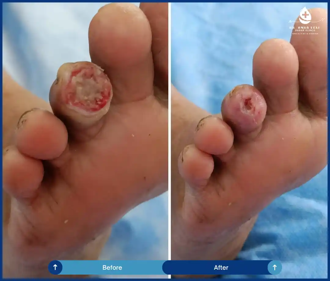 Diabetic Foot Ulcer Treatment and Recovery Img3
