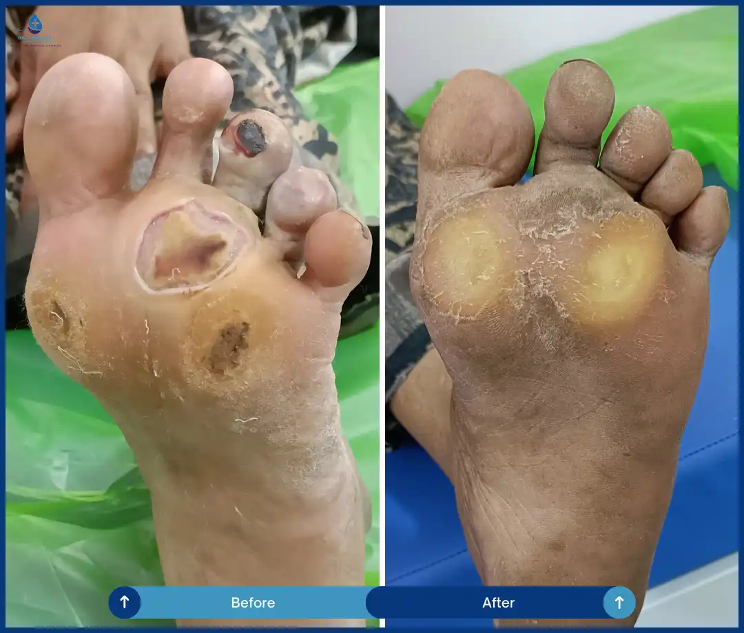 High Risk Diabetic Foot Problems