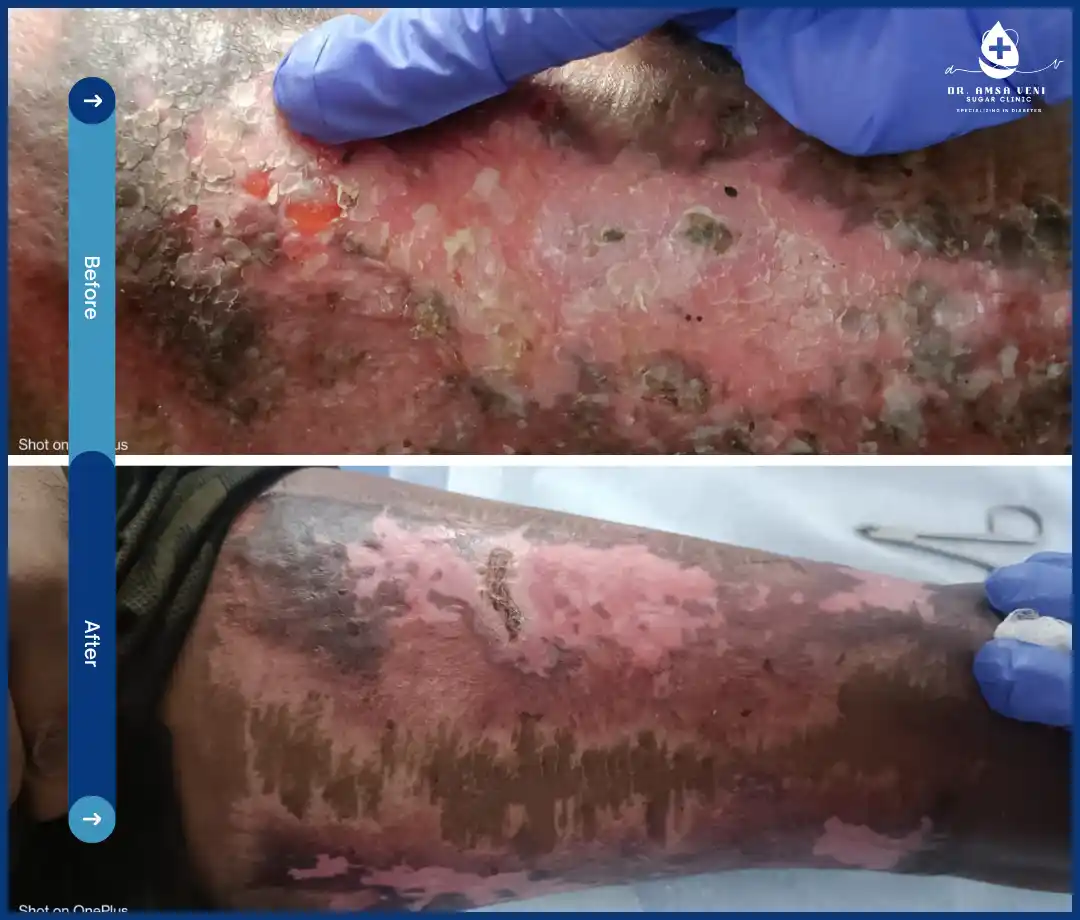 Treatment for Diabetic Foot Ulcer Img10