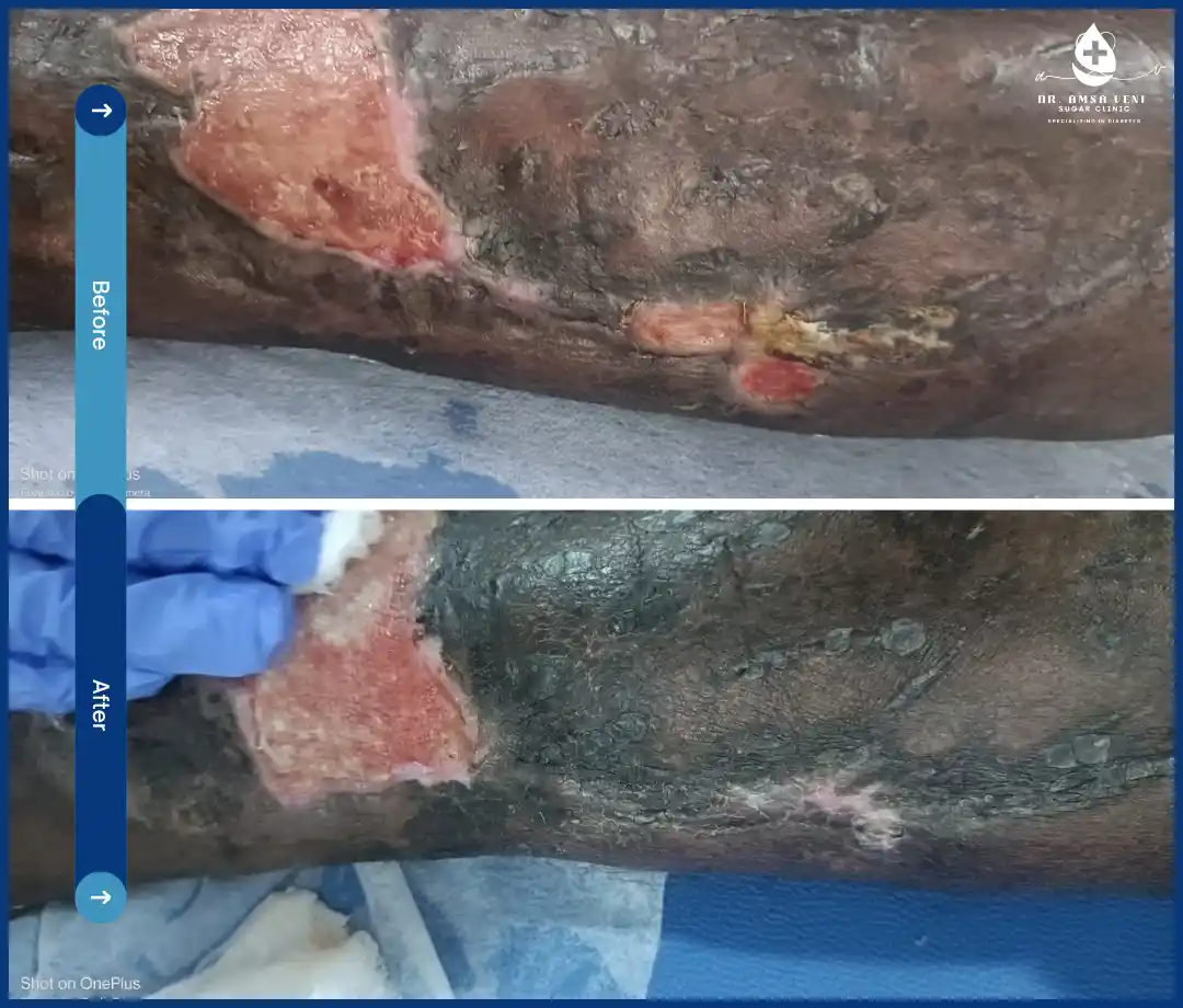 Treatment for Diabetic Foot Ulcer Img11