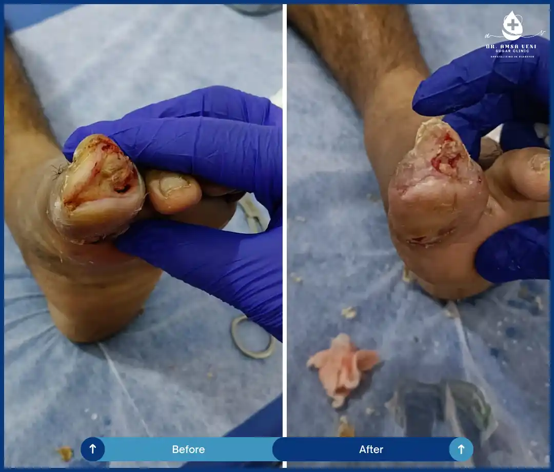 Treatment for Diabetic Foot Ulcer Img8
