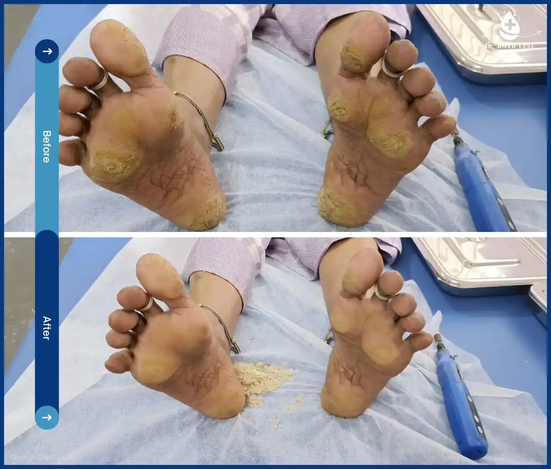 Treatment for Diabetic Foot Ulcer Img9
