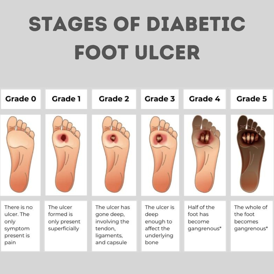 stages of diabetic foot ulcer - Dr. Amsaveni